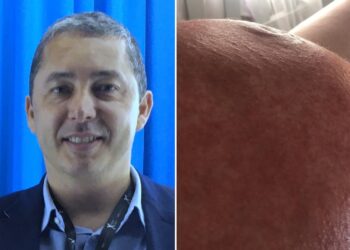 Conheça a PUPP: doença que atinge 1 em cada 200 grávidas e pode causar lesões e sofrimento emocional