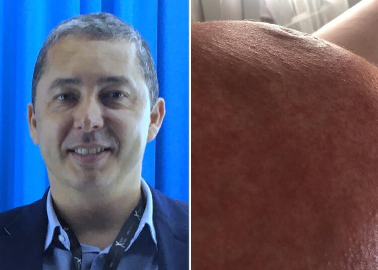 Conheça a PUPP: doença que atinge 1 em cada 200 grávidas e pode causar lesões e sofrimento emocional